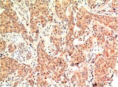 Immunohistochemistry of paraffin-embedded Human breast carcinoma tissue using ERK 1 Monoclonal Antibody at dilution of 1:200.