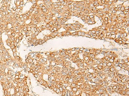 Immunohistochemistry of paraffin-embedded Human liver cancer tissue using KRT9 Polyclonal Antibody at dilution of 1:30(×200)