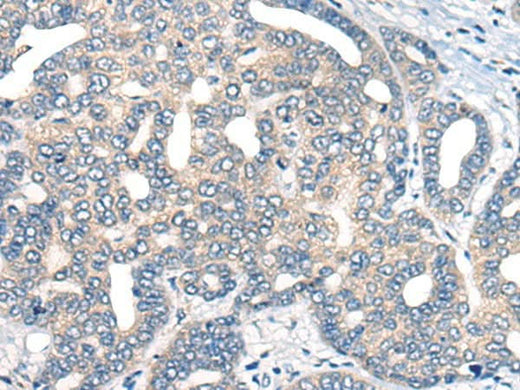 Immunohistochemistry of paraffin-embedded Human liver cancer tissue using AURKA Polyclonal Antibody at dilution of 1:40(×200)