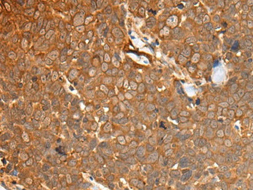 Immunohistochemistry of paraffin-embedded Human thyroid cancer tissue using CAD Polyclonal Antibody at dilution of 1:50(×200)