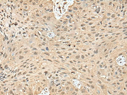 Immunohistochemistry of paraffin-embedded Human lung cancer tissue using ATXN3 Polyclonal Antibody at dilution of 1:50(×200)