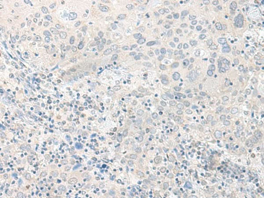 Immunohistochemistry of paraffin-embedded Human cervical cancer tissue using TIMM8A Polyclonal Antibody at dilution of 1:50(×200)