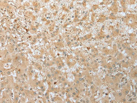 Immunohistochemistry of paraffin-embedded Human liver cancer tissue using FNDC3B Polyclonal Antibody at dilution of 1:45(×200)