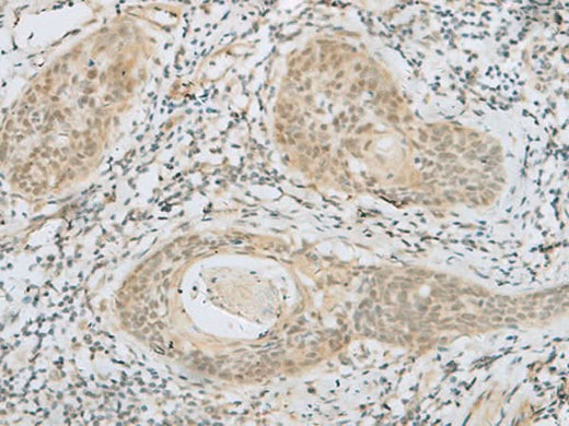 Immunohistochemistry of paraffin-embedded Human esophagus cancer tissue using HELT Polyclonal Antibody at dilution of 1:40(×200)