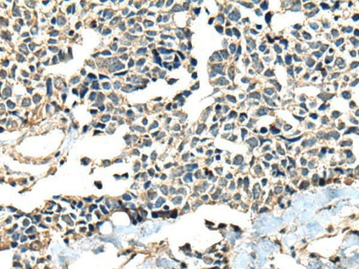 Immunohistochemistry of paraffin-embedded Human lung cancer tissue using CALHM1 Polyclonal Antibody at dilution of 1:60(×200)