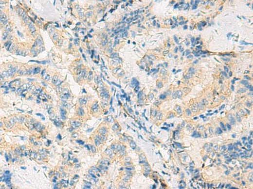 Immunohistochemistry of paraffin-embedded Human thyroid cancer tissue using SYNGR1 Polyclonal Antibody at dilution of 1:50(×200)