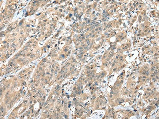 Immunohistochemistry of paraffin-embedded Human colorectal cancer tissue using HIF1A Polyclonal Antibody at dilution of 1:45(×200)