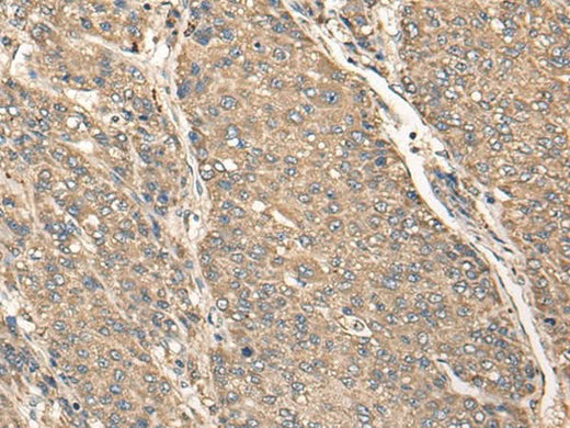 Immunohistochemistry of paraffin-embedded Human liver cancer tissue using C17orf67 Polyclonal Antibody at dilution of 1:50(×200)