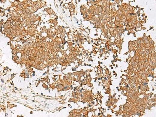 Immunohistochemistry of paraffin-embedded Human lung cancer tissue using GSTM2 Polyclonal Antibody at dilution of 1:50(×200)