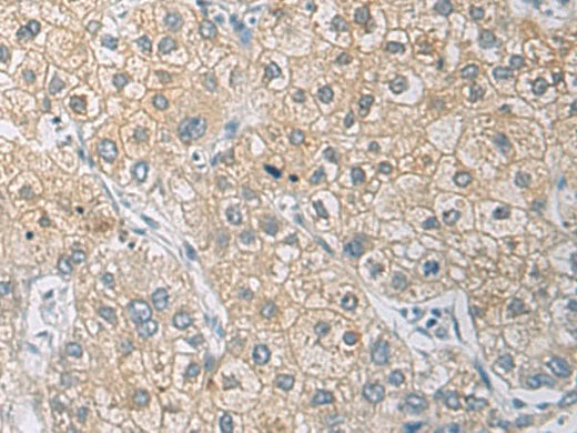 Immunohistochemistry of paraffin-embedded Human liver cancer tissue using IL1RN Polyclonal Antibody at dilution of 1:50(×200)