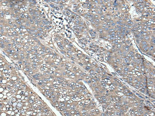 Immunohistochemistry of paraffin-embedded Human liver cancer tissue using UNC13B Polyclonal Antibody at dilution of 1:85(×200)