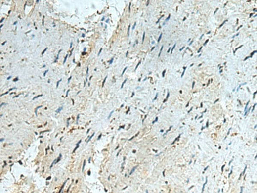 Immunohistochemistry of paraffin-embedded Human gastric cancer tissue using RAPSN Polyclonal Antibody at dilution of 1:40(×200)