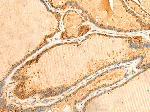 Immunohistochemistry of paraffin-embedded Human thyroid cancer tissue using PPM1B Polyclonal Antibody at dilution of 1:50(×200)