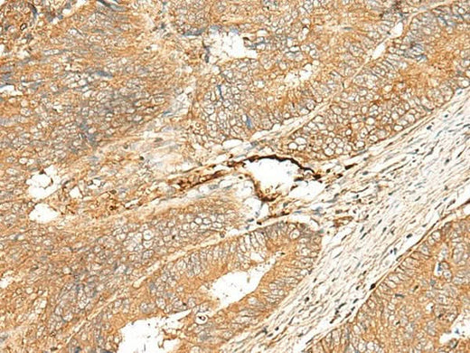 Immunohistochemistry of paraffin-embedded Human colorectal cancer tissue using ADGRF5 Polyclonal Antibody at dilution of 1:40(×200)