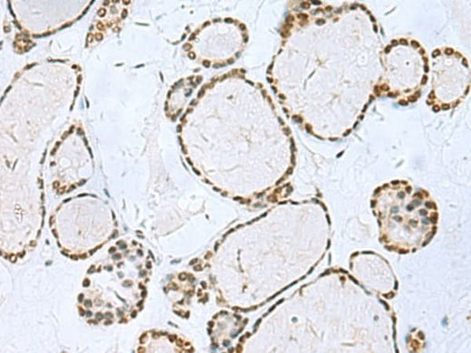 Immunohistochemistry of paraffin-embedded Human thyroid cancer tissue using TH Polyclonal Antibody at dilution of 1:40(×200)