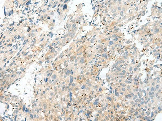 Immunohistochemistry of paraffin-embedded Human cervical cancer tissue using NXNL1 Polyclonal Antibody at dilution of 1:45(×200)