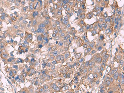 Immunohistochemistry of paraffin-embedded Human liver cancer tissue using KCNN3 Polyclonal Antibody at dilution of 1:60(×200)