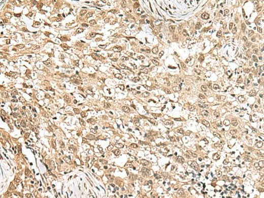 Immunohistochemistry of paraffin-embedded Human esophagus cancer tissue using RPS6KA5 Polyclonal Antibody at dilution of 1:160(×200)