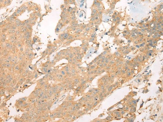 Immunohistochemistry of paraffin-embedded Human colorectal cancer tissue using ASIC3 Polyclonal Antibody at dilution of 1:40(×200)