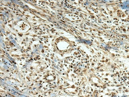 Immunohistochemistry of paraffin-embedded Human breast cancer tissue using MLF1 Polyclonal Antibody at dilution of 1:105(×200)