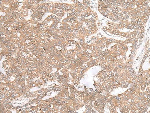 Immunohistochemistry of paraffin-embedded Human liver cancer tissue using PTP4A3 Polyclonal Antibody at dilution of 1:40(×200)