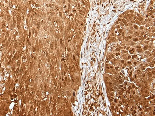 Immunohistochemistry of paraffin-embedded Human lung cancer tissue using UBA7 Polyclonal Antibody at dilution of 1:35(×200)