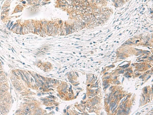 Immunohistochemistry of paraffin-embedded Human colorectal cancer tissue using IDUA Polyclonal Antibody at dilution of 1:35(×200)