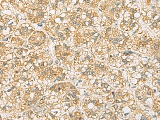 Immunohistochemistry of paraffin-embedded Human liver cancer tissue using FAAP100 Polyclonal Antibody at dilution of 1:65(×200)