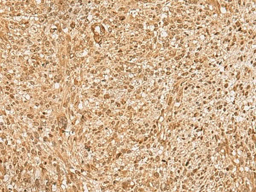 Immunohistochemistry of paraffin-embedded Human liver cancer tissue using HIRIP3 Polyclonal Antibody at dilution of 1:60(×200)
