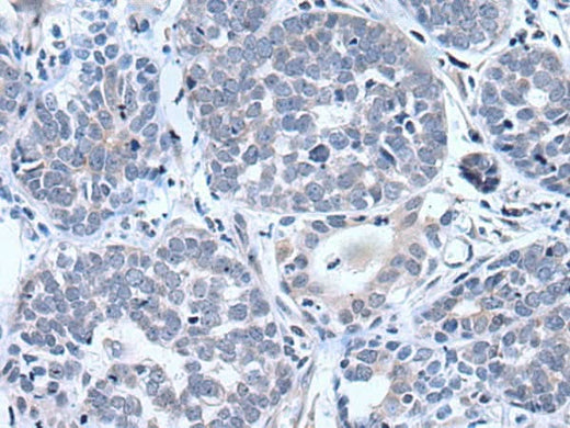 Immunohistochemistry of paraffin-embedded Human esophagus cancer tissue using BTG4 Polyclonal Antibody at dilution of 1:55(×200)