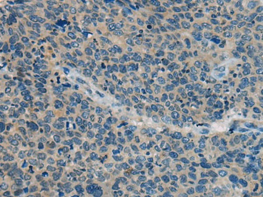 Immunohistochemistry of paraffin-embedded Human cervical cancer tissue using BACE2 Polyclonal Antibody at dilution of 1:45(×200)