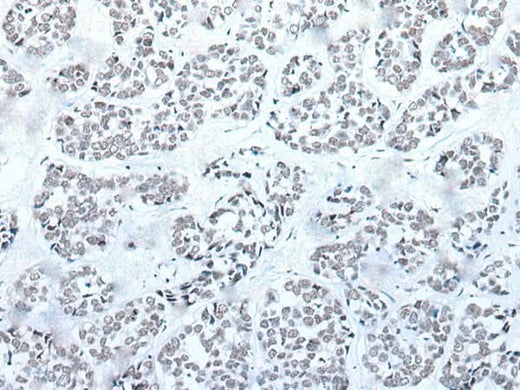 Immunohistochemistry of paraffin-embedded Human esophagus cancer tissue using BRD3 Polyclonal Antibody at dilution of 1:60(×200)