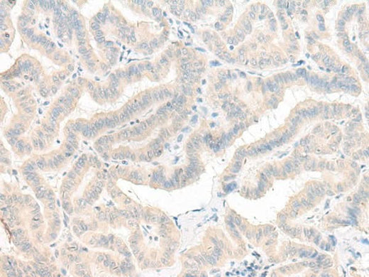 Immunohistochemistry of paraffin-embedded Human thyroid cancer tissue using AOAH Polyclonal Antibody at dilution of 1:25(×200)