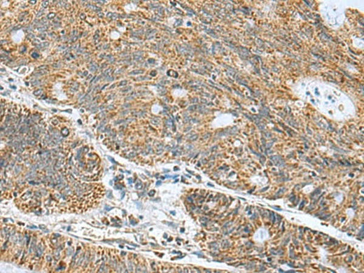 Immunohistochemistry of paraffin-embedded Human colorectal cancer tissue using MRPL40 Polyclonal Antibody at dilution of 1:50(×200)