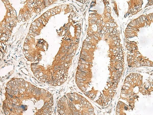Immunohistochemistry of paraffin-embedded Human colorectal cancer tissue using FERD3L Polyclonal Antibody at dilution of 1:85(×200)