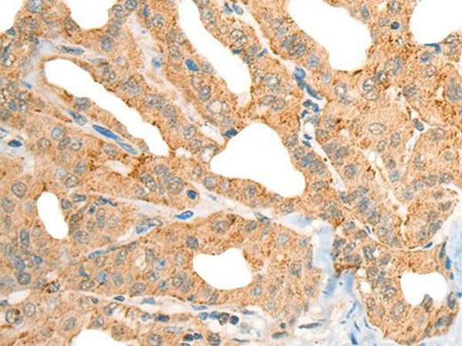 Immunohistochemistry of paraffin-embedded Human thyroid cancer tissue using CECR1 Polyclonal Antibody at dilution of 1:40(×200)