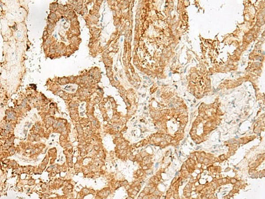 Immunohistochemistry of paraffin-embedded Human thyroid cancer tissue using ADGRF1 Polyclonal Antibody at dilution of 1:25(×200)