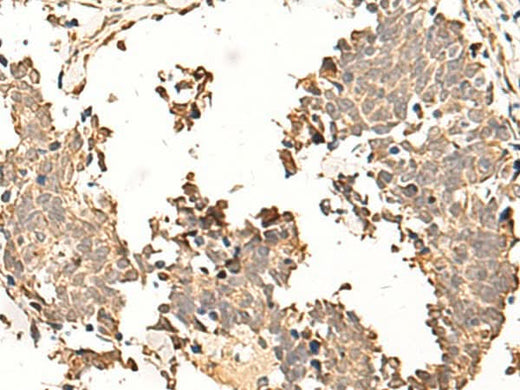 Immunohistochemistry of paraffin-embedded Human lung cancer tissue using SOX3 Polyclonal Antibody at dilution of 1:50(×200)