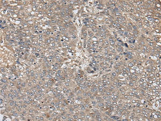 Immunohistochemistry of paraffin-embedded Human liver cancer tissue using ZFP36 Polyclonal Antibody at dilution of 1:40(×200)