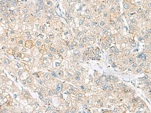 Immunohistochemistry of paraffin-embedded Human liver cancer tissue using FARP2 Polyclonal Antibody at dilution of 1:55(×200)