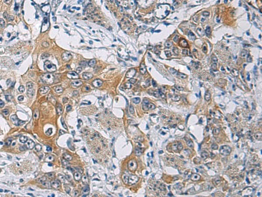 Immunohistochemistry of paraffin-embedded Human esophagus cancer tissue using KCNJ10 Polyclonal Antibody at dilution of 1:60(×200)