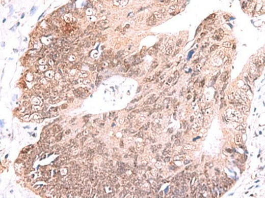 Immunohistochemistry of paraffin-embedded Human colorectal cancer tissue using RUSC1 Polyclonal Antibody at dilution of 1:65(×200)