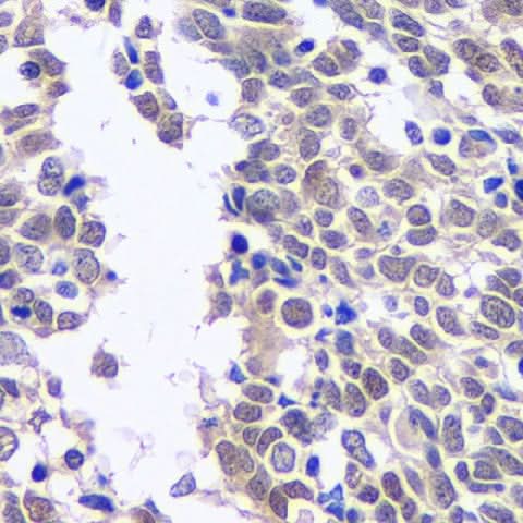 Immunohistochemistry analysis of paraffin-embedded human lung cancer using CREB1 Polyclonal Antibody at dilution of 1:200.