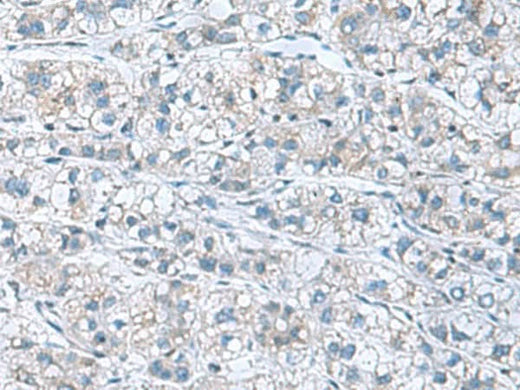 Immunohistochemistry of paraffin-embedded Human liver cancer tissue using GDF9 Polyclonal Antibody at dilution of 1:55(×200)