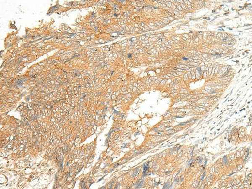 Immunohistochemistry of paraffin-embedded Human colorectal cancer tissue using C5AR2 Polyclonal Antibody at dilution of 1:25(×200)