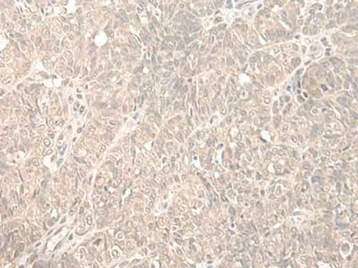 Immunohistochemistry of paraffin-embedded Human ovarian cancer tissue using HENMT1 Polyclonal Antibody at dilution of 1:35(×200)