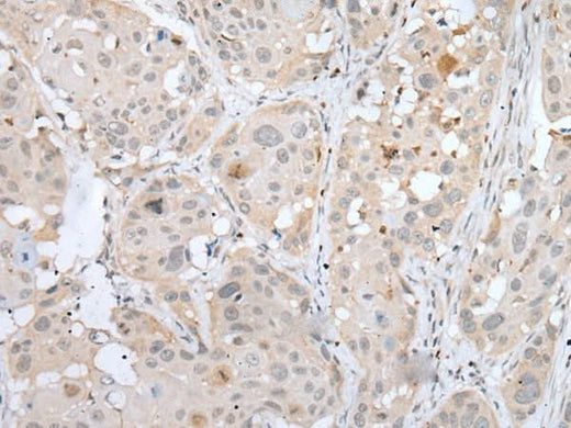 Immunohistochemistry of paraffin-embedded Human esophagus cancer tissue using BORCS8 Polyclonal Antibody at dilution of 1:50(×200)