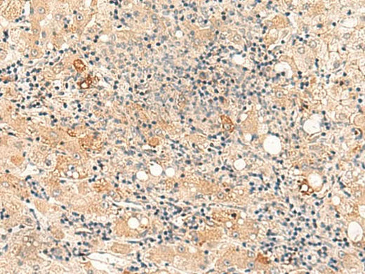 Immunohistochemistry of paraffin-embedded Human liver cancer tissue using SULT4A1 Polyclonal Antibody at dilution of 1:50(×200)