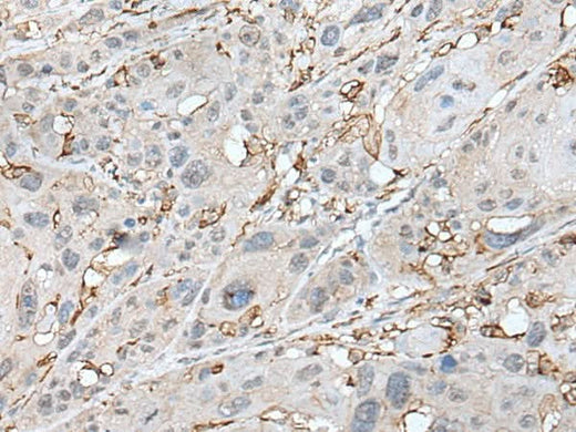 Immunohistochemistry of paraffin-embedded Human esophagus cancer tissue using CD14 Polyclonal Antibody at dilution of 1:40(×200)
