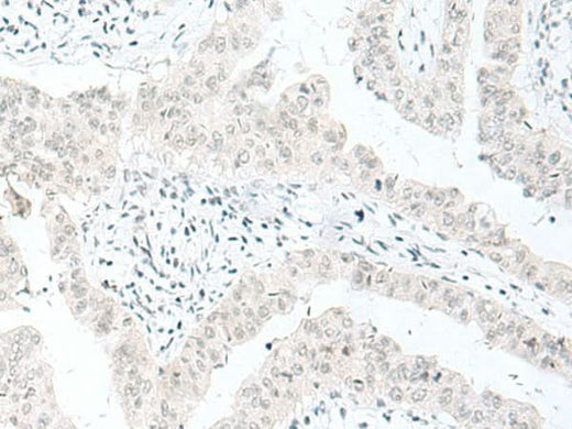 Immunohistochemistry of paraffin-embedded Human liver cancer tissue using ENSA Polyclonal Antibody at dilution of 1:70(×200)